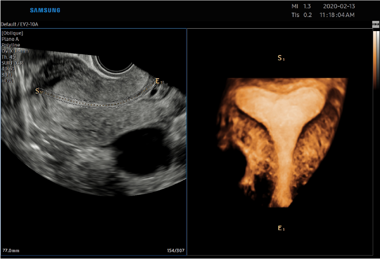 Uterine Contour