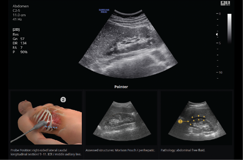 Abdomen con EzAssist™