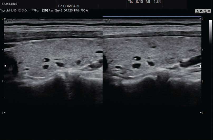 Tiroides con EzCompare™