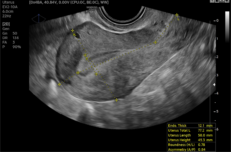 UterineAssist™