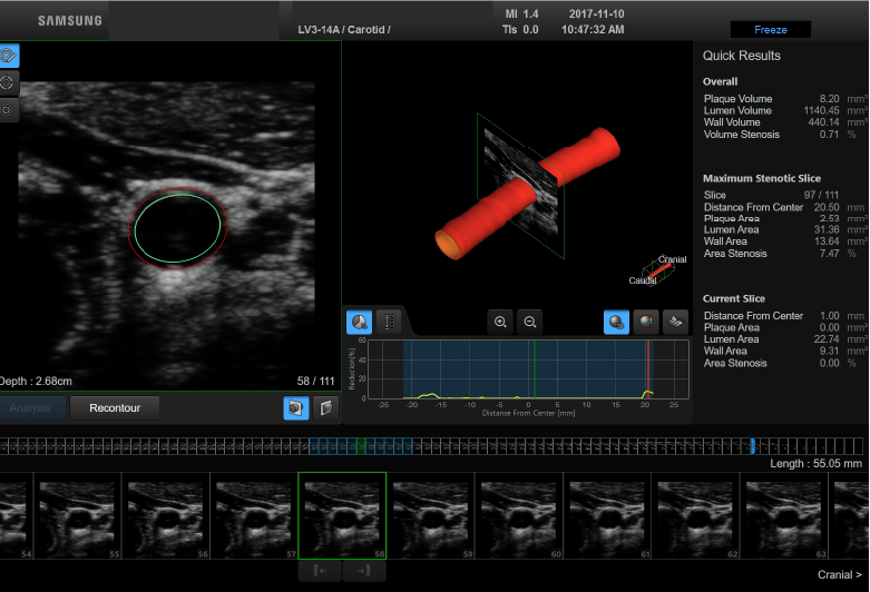 S-3D Arterial Analysis™