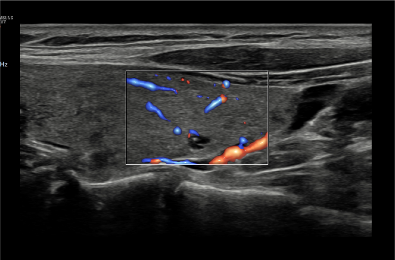 5D Follicle