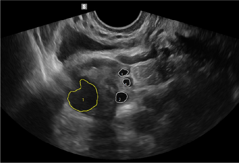 2D Follicle