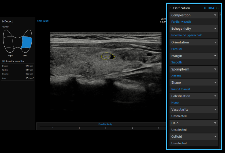 S-Detect™ para tiroides
